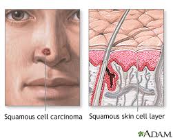 squamous cell skin cancer medlineplus