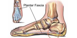 plantar fascia tear how to recover