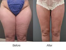 lipedema treatment beverly hills