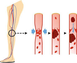 Le caillot peut se former dans une veine ou dans une artère. Thrombose Arterielle Und Venose Thrombosen Prophylaxe Draco