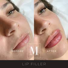 lip and augmentation with dermal