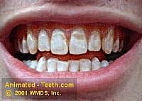 Dental fluorosis is a condition that causes changes in the appearance of tooth enamel. Dental Fluorosis Causes Prevention Treatment Pictures