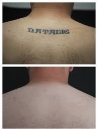 No regrets tattoo removal sallychantler. Regret Your Tattoo Here S Advice On How To Get Rid Of It