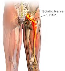 sciatica pain shelby family chiropractic