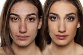 acne before after stock photos royalty
