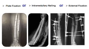 forearm intramedullary nail system