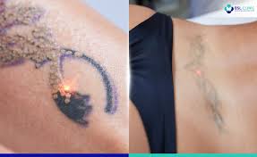 laser tattoo removal bangkok