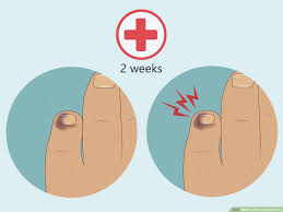 how to heal a bruised toe 11 steps