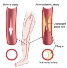 Peripheral Arterial Disease Fact Sheet Data Statistics