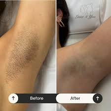 Behold the transformation! Checkout this incredible before-and-after  results of our Underarm Laser Hair Removal. 🌟 Dive into a world where … |  Instagram