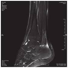 Haglund syndrome characterised by a prominent posterior bursal projection of calcaneum, achilles tendinosis v.the haglund syndrome: Mri Of Tendon Calcification Caused By Haglund S Syndrome Mri Magnetic Download Scientific Diagram