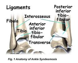 Image result for ankle sprain images public. This image illustrates and identifies the ankle ligaments involved in a High Ankle Sprain. 