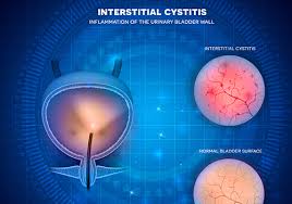 intersial cysis painful bladder