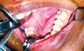 swelling on the floor of the mouth on