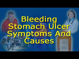 bleeding ulcer symptoms and causes