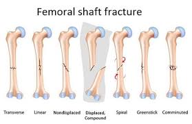 editing fem shaft fractures