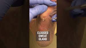 doctor removes clogged sweat gland on