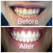 teeth whitening golla center for