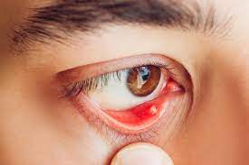 Ik heb een pijnlijk rood bultje in mijn ooglid | Thuisarts.nl