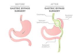 roux en y gastric byp surgery in