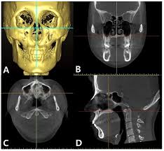 a cbct evaluation of midpalatal bone