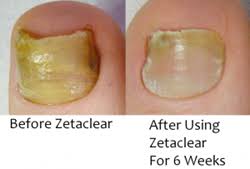 zetaclear nail fungus treatment now