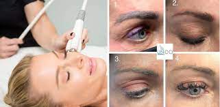 can permanent makeup be removed