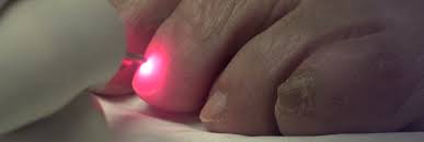 laser treatment for fungal toenails