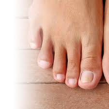 fungal nail infection an overview