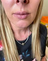 botched filler gave me hot dog lips