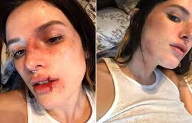 bella thorne faces backlash for bruised