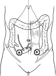 The most popular diversions to date are made from ileal or ileocolonic segments. Ipsilateral Ileal Conduit Placement At Vertical Rectus Abdominis Myocutaneous Flap Donor Site In Pelvic Exenteration Springerlink