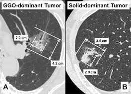 clinical t2an0m0 lung adenocarcinoma