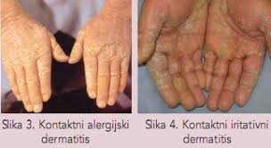 Slikovni rezultat za kontaktni alergijski dermatitis