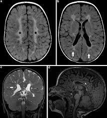 We did not find results for: Neuroimaging Pathology In Cerebral Palsy Springerlink