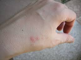 Основната разлика между ухапвания от дървеници и ухапвания от комари е, че дървеница има навика да хапе в редовна линия или зигзаг. Drvenicite Imat Lyubimi Cvetove