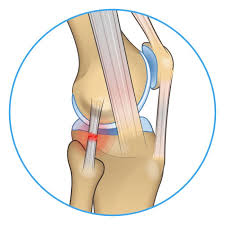 knee pain on outside of joint four