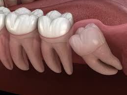 best remes for wisdom tooth pain relief