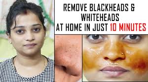 home remes for whiteheads and