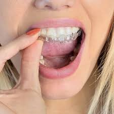 Along with front teeth gap filling, the braces treatment also helps to make the teeth alignment in symmetrical order. What Is Diastema How To Fill Gaps Between Teeth Dentist In Santa Rosa