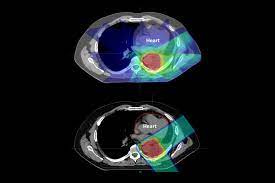 proton therapy for cancer lowers risk