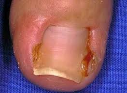 ingrown toenails city glebe podiatry