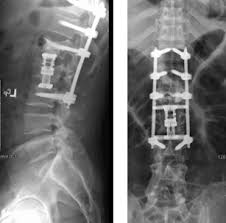 The fracture line breaches both the anterior and posterior vertebral body cortex and the anterior superior endplate. Case Study Repair Of L1 L2 Burst Fractures The Healthy Spine Blog