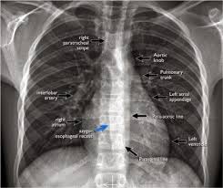 An online course by lee herrington. Chest X Ray Part 1 Normal Anatomy And Itsvariants Radiology X Ray Radiology Imaging