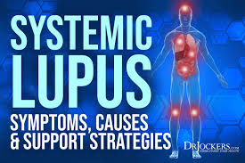 systemic lupus symptoms causes and