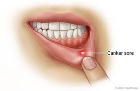 canker sore video image