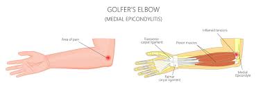 golfer s elbow condition