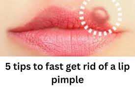 5 tips to fast get rid of a lip pimple