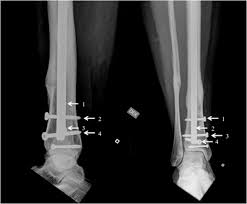 tibial intramedullary nail removal