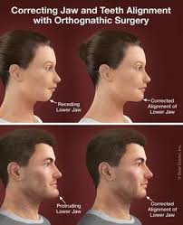 orthognathic surgery corrective jaw